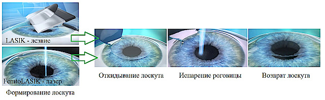 Этапы лазерной коррекции зрения по методам LASIK и Femto-LASIK