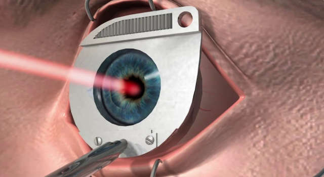 Операция при близорукости - лазерная коррекция зрения