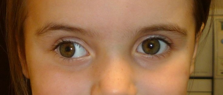 Экзотропия глаза