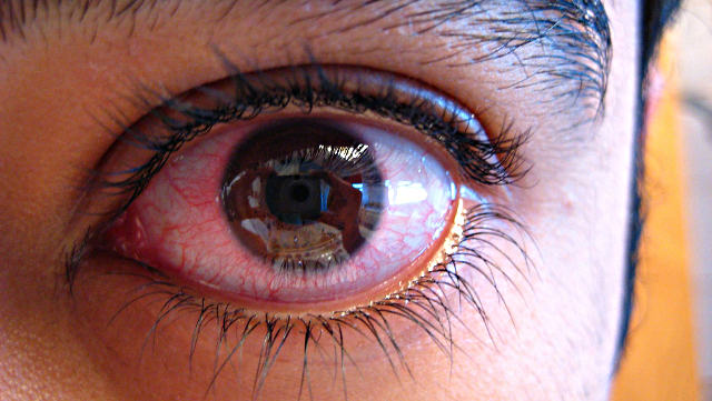 Эписклерит глаза - симптомы