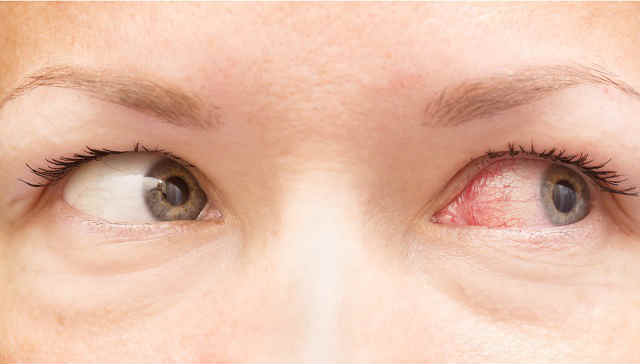 Глазное давление - симптомы и признаки