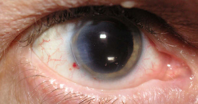 Лазерная корреция зрения - осложнения, риски