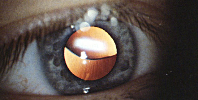 Люксация (сублюксация) хрусталика глаза