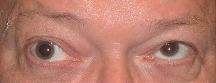 Офтальмоплегия глаза
