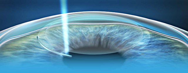 Фемто Супер ЛАСИК (Femto Super LASIK) - операция лазерной коррекции зрения