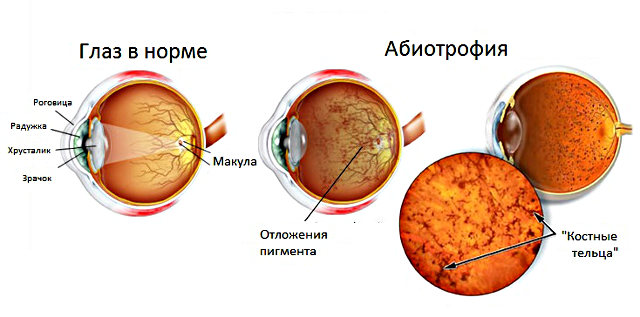 Пигментная (тапеторетинальная) абиотрофия сетчатки (пигментный ретинит)