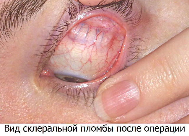 Реабилитация после пломбирования сетчатки глаза