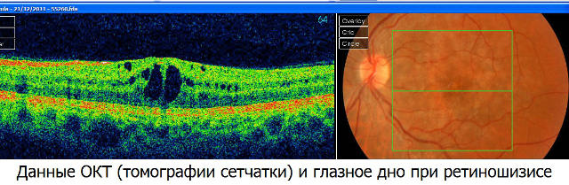 Ретиношизис - расслоение сетчатки глаза