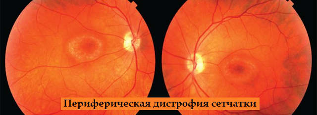 Периферические дистрофии сетчатки обоих глаз