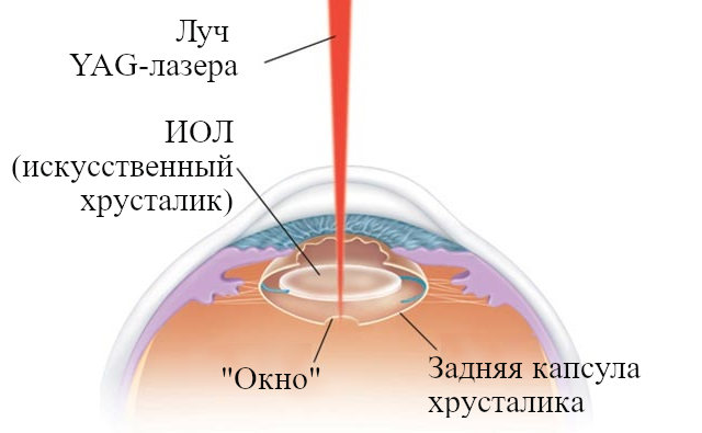 Лечение вторичной катаракты в Москве