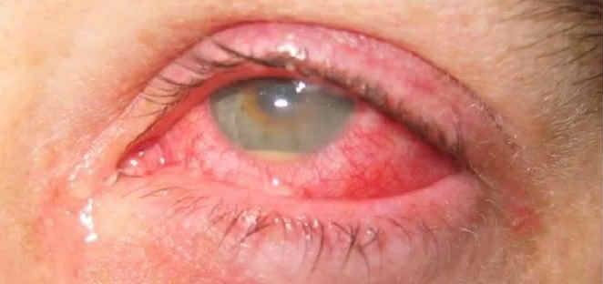 Панувеит глаза симптомы