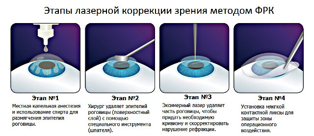 Операция лазерной коррекции зрения методом ФРК