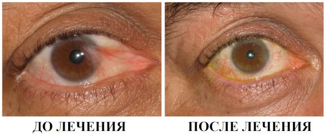 Лечение птеригиума глаза - хирургическая операция