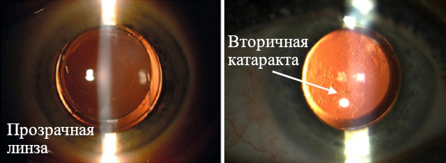 Вторичная катаракта после замены хрусталика глаза