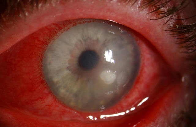Язва роговицы как осложнение нелеченого синдрома сухого (красного) глаза