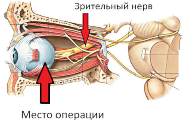 Операции при частичной атрофии зрительного нерва ЧАЗН