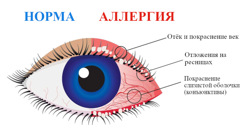 Аллергия на веках глаз лечение и диагностика
