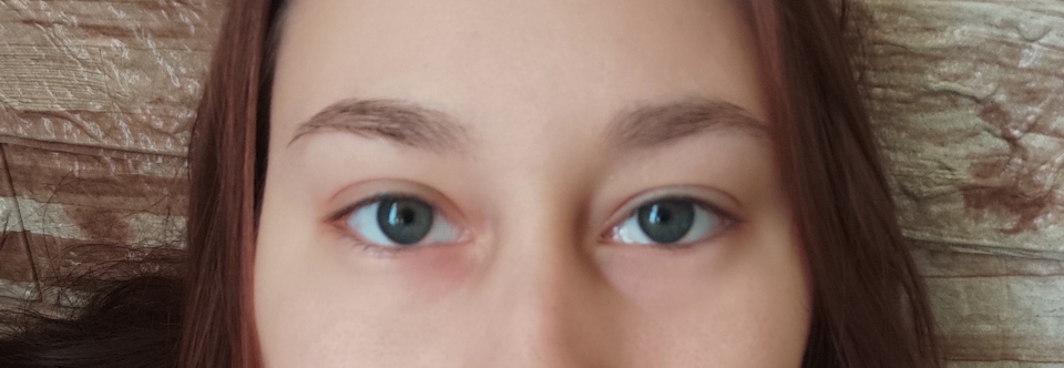Асимметрия глаз при астено-невротическом синдроме