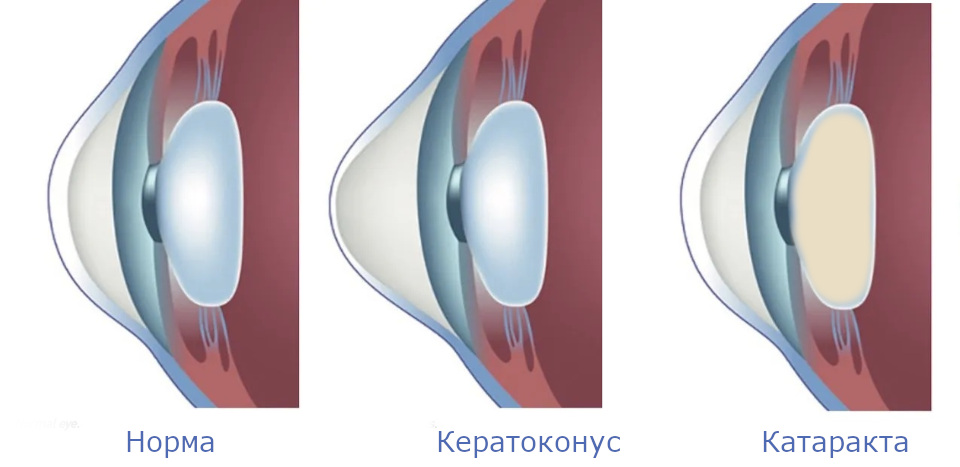 Отличие катаракты от кератоконуса