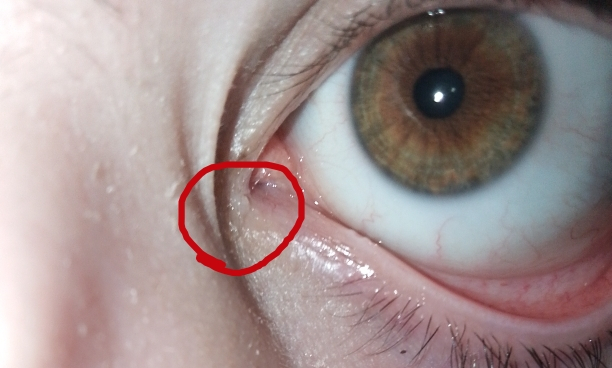 Снижение зрения после попадания дезодоранта в глаз