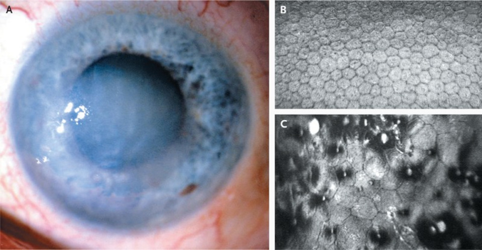 Эндотелиально-эпителиальная дистрофия роговицы (ЭЭД) как осложнение хирургии катаракты: А - внешний вид роговицы, B - нормальное количество эндотелиоцитов, C - увеличение площади, но уменшение количества клеток при дистрофии