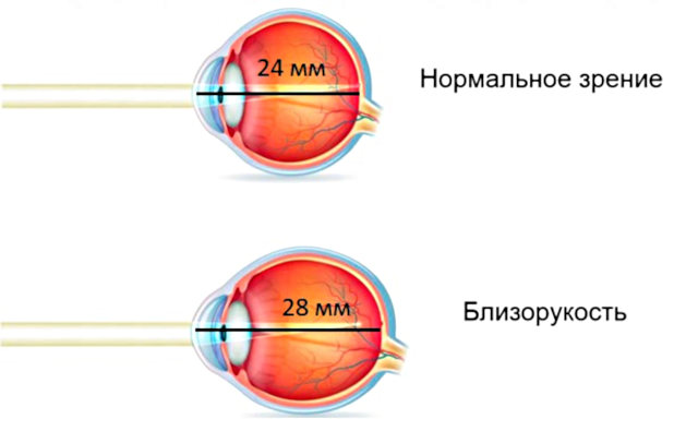 Длина глаза при близорукости (ПЗО) передне зандяя ось