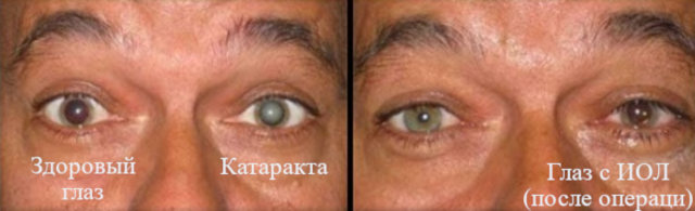 Глаз до и после операции по удалению катаракты методом факоэмульсификации