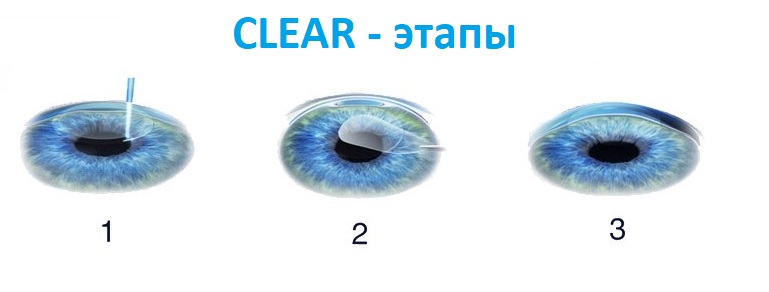 Этапы лазерной коррекции зрения CLEAR (КЛИР)