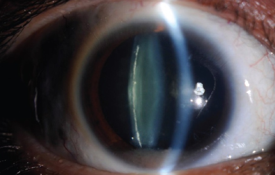 Факосклероз хрусталика глаза