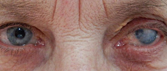 Бельмо - помутнение роговицы глаза