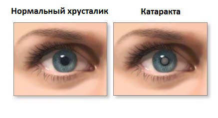 Начальная стадия катаракты