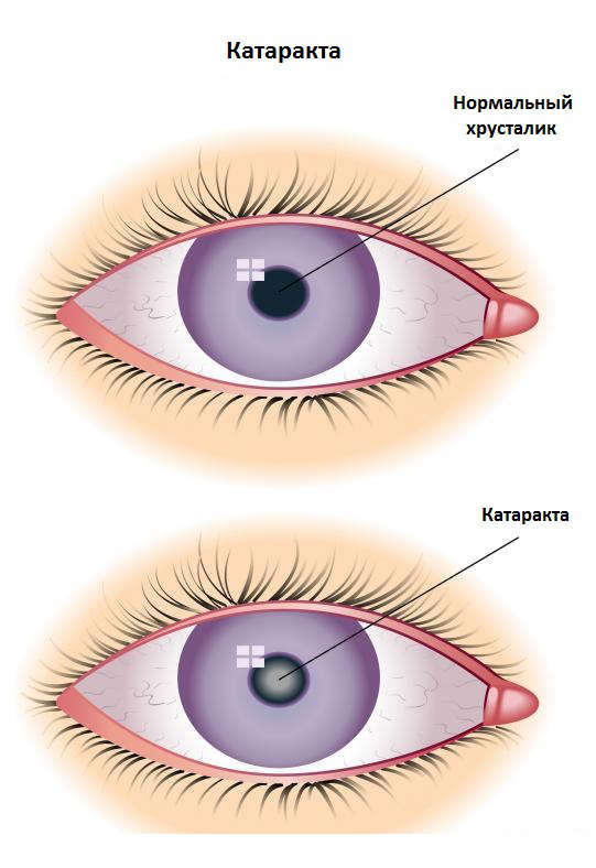 Катаракта глаза незрелая (операция)