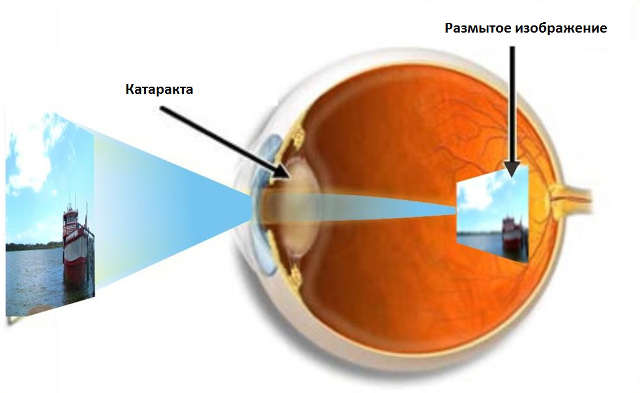 Причины развития катаракты 