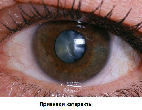 Признаки катаракты