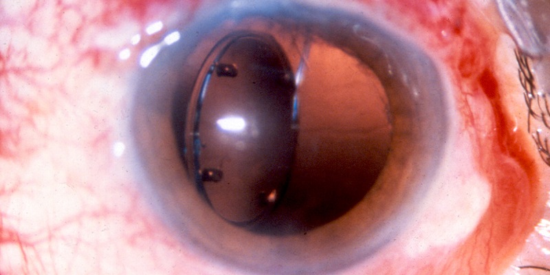 Дислокация искусственного хрусталика глаза