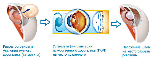 ЭЭК - экстракапсулярная экстракция катаракты