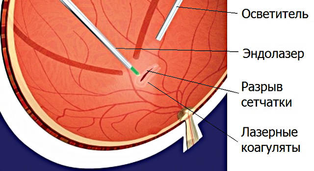 Эндолазерная коагуляция сетчатки глаза