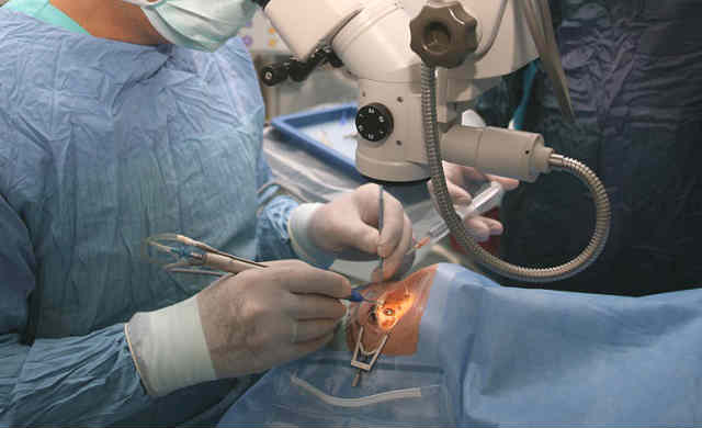 Операция экстракапсулярной экстракции катаракты - осложнения и стоимость