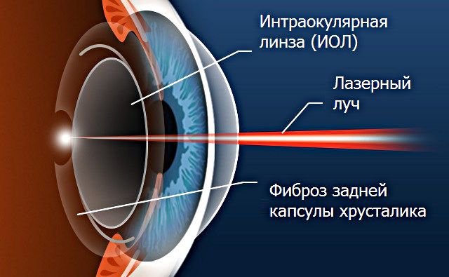 Фиброз задней капсулы хрусталика глаза - цены на лечение
