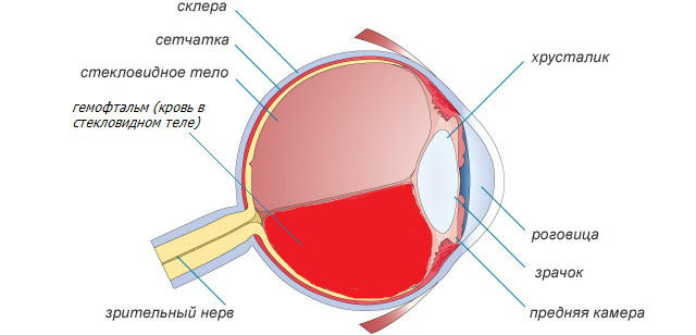 Гемофтальм глаза - тотальный, частичный и рецидивирующий