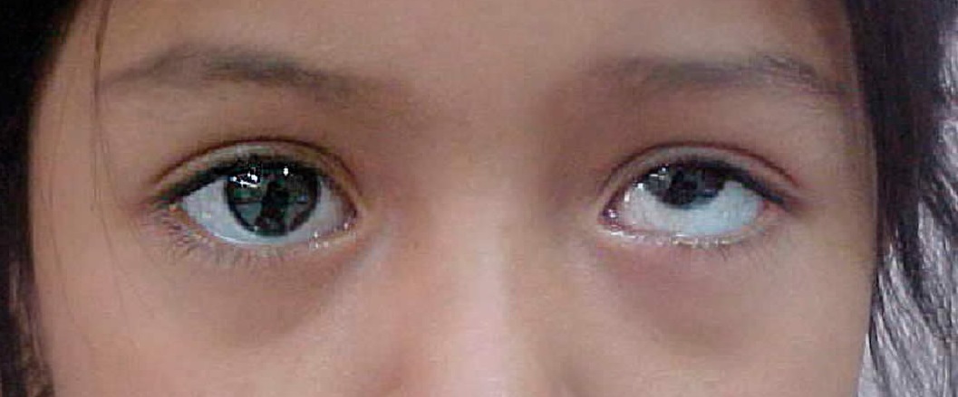 Гипертропия глаза причины и лечение