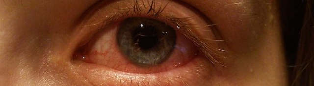 Острый приступ глаукомы - симптомы