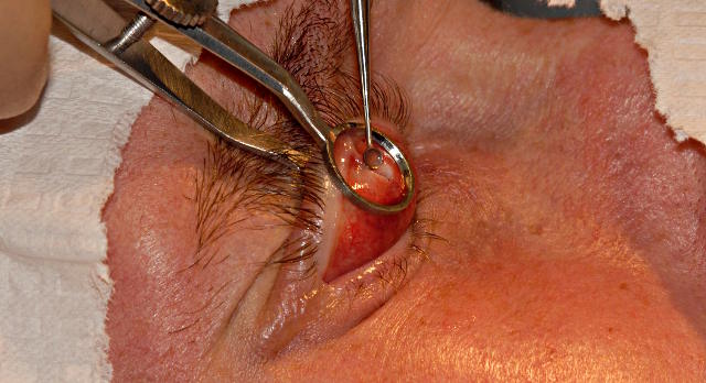 Хирургическое удаление халязиона верхнего или нижнего века глаза