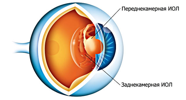 Хорошие интраокулярные линзы (ИОЛ) при катаракте