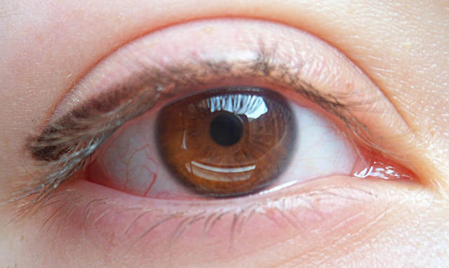 Конъюнктивит глаза: острый и хронический