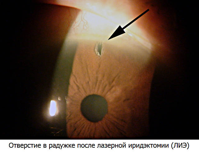 Лазерная иридотомия при глаукоме