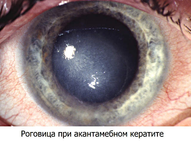 Кератит роговицы глаза - симптомы (признаки)