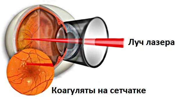 Лазерные методы лечения заболеваний сетчатки глаза