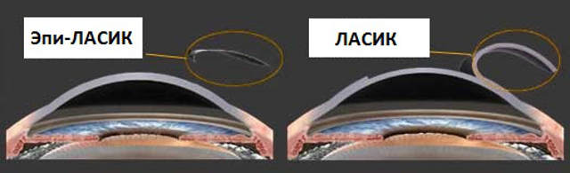 Эпи-ЛАСИК - лазерная коррекция зрения 