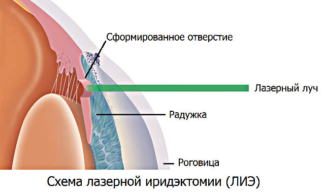 ЛИЭ - лазерная иридэктомия при глаукоме
